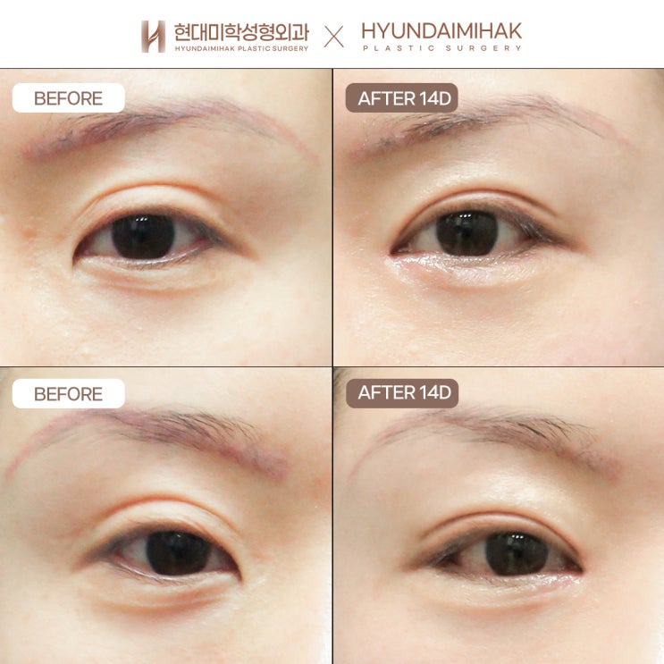 Hạ đường nếp mí đôi khi nếp mí dày như “mí xúc xích”