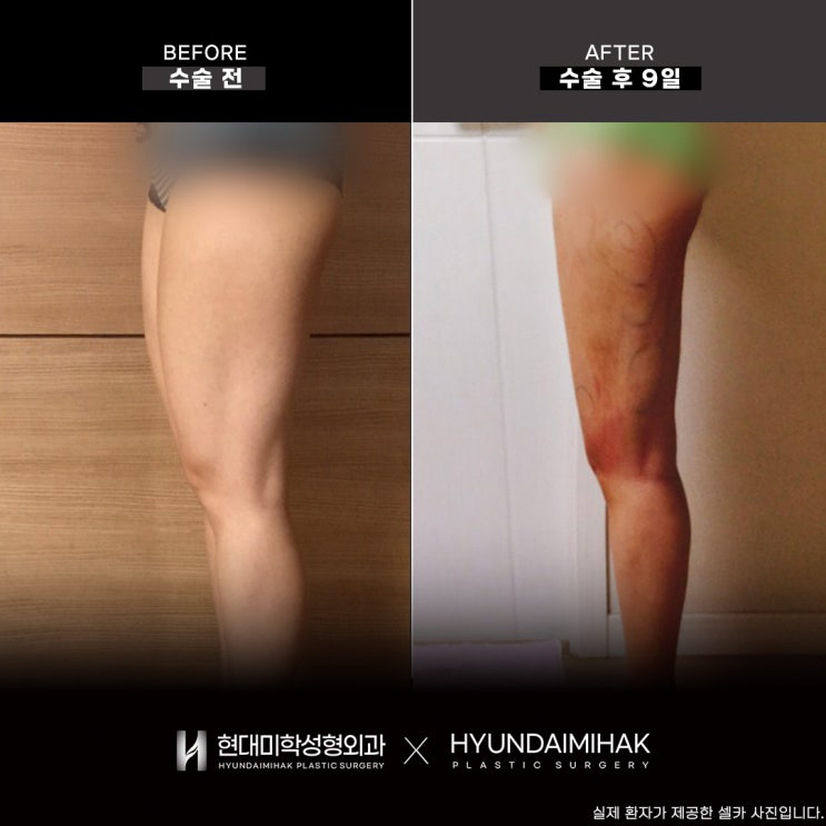 Lựa chọn cơ sở phẫu thuật hút mỡ có thể thay đổi vóc dáng của bạn