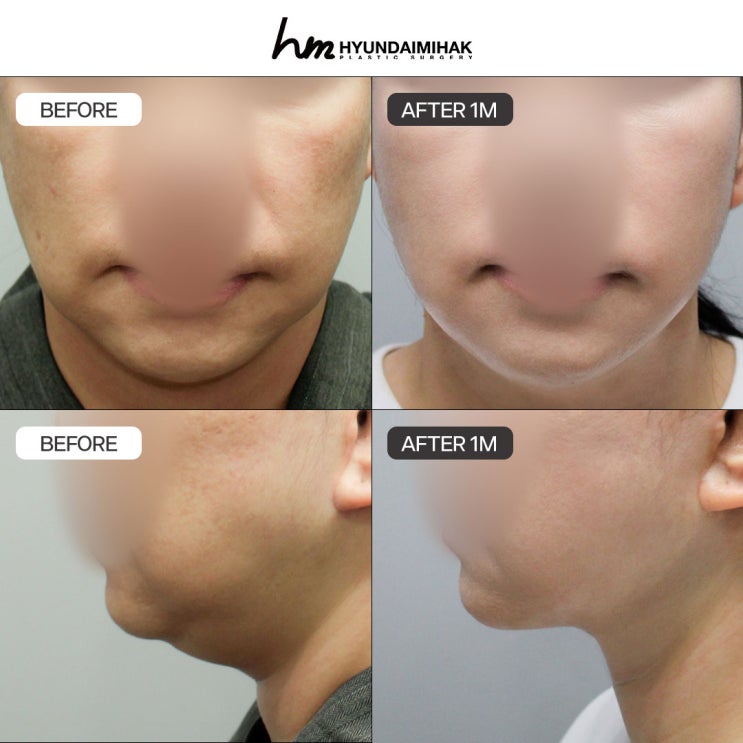 Căng chỉ khu vực ga Sinsa: từ hiệu quả đến ưu nhược điểm theo từng loại chỉ