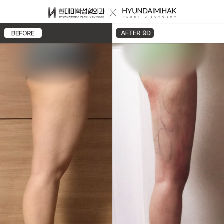Hút mỡ petite: phương pháp hoàn thiện đường nét cơ thể đơn giản, giúp chấm dứt nỗi băn khoăn chỉ trong một ngày