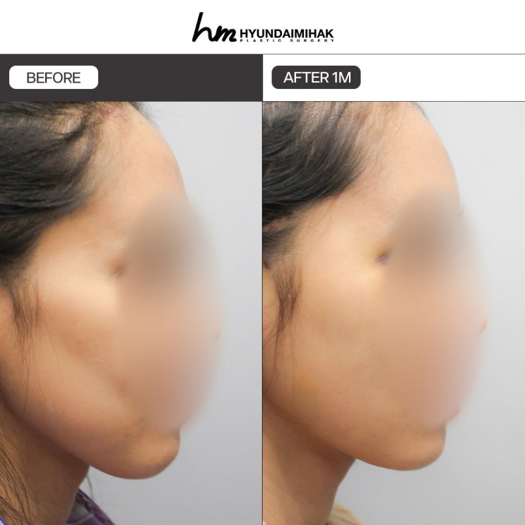 Tiêm tan mỡ mặt, hoàn thiện đường nét thon gọn tự nhiên và săn chắc