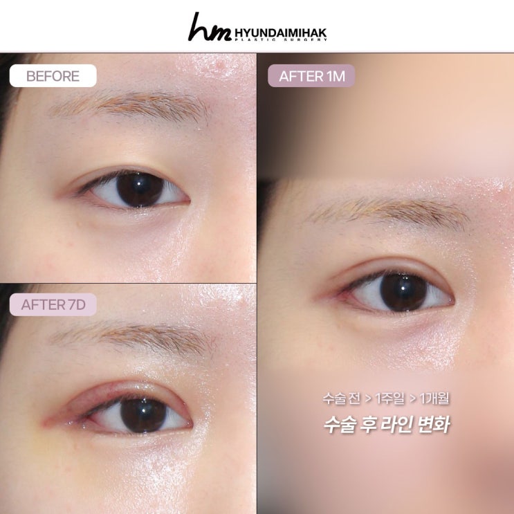 Review mở rộng khóe mắt kép: Cách cải thiện rõ rệt đôi mắt nhỏ và trông bí bách