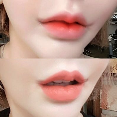 Giải tỏa nỗi lo với phẫu thuật nhân trung