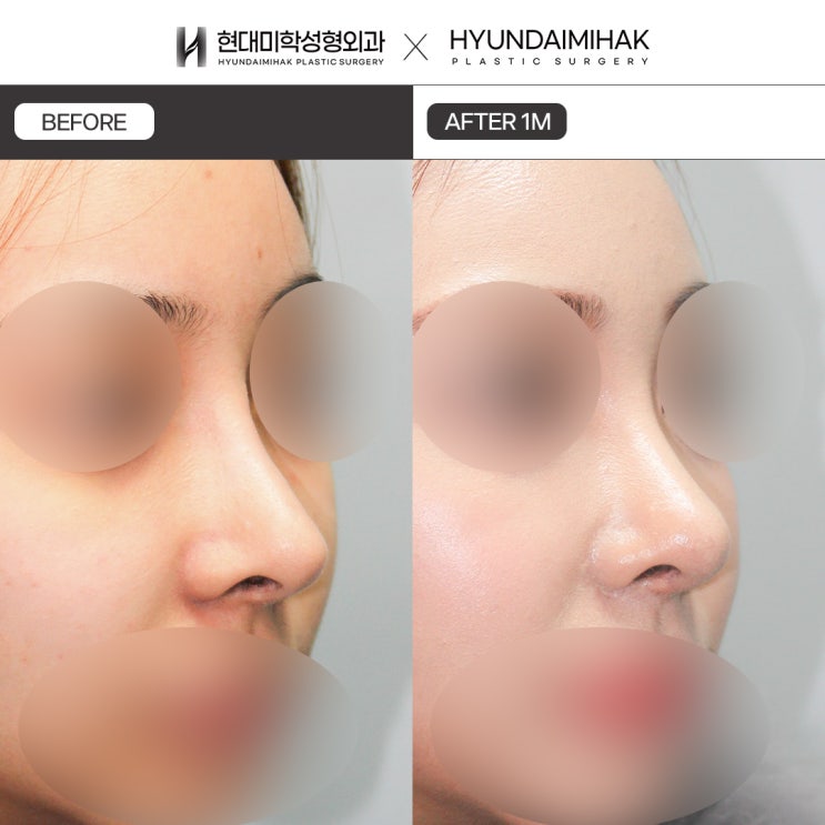Bệnh viện giỏi phẫu thuật sửa mũi: giúp dáng mũi nhân tạo trở nên tự nhiên