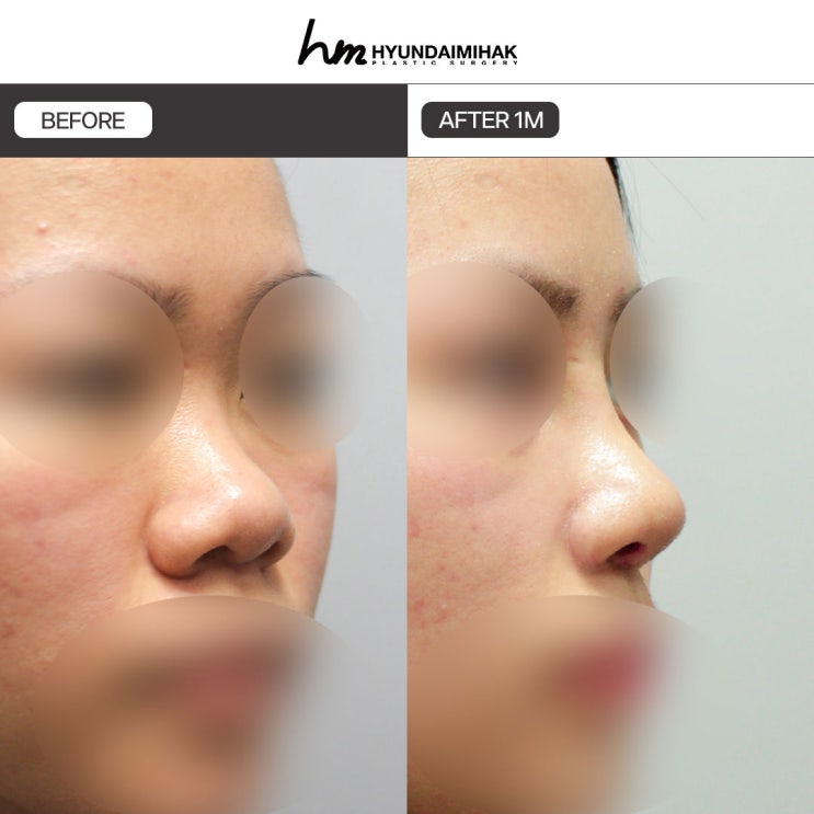 Thu gọn cánh mũi: thay đổi nhỏ nhưng rõ rệt