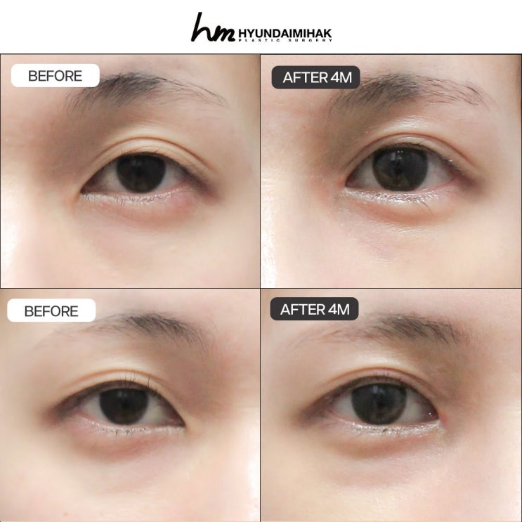 Phẫu thuật tái tạo khóe mắt trong: kỹ thuật phục hồi và tái tạo tự nhiên, tinh tế | Tổng hợp đối tượng phù hợp, phương pháp phẫu thuật và thời gian hồi phục