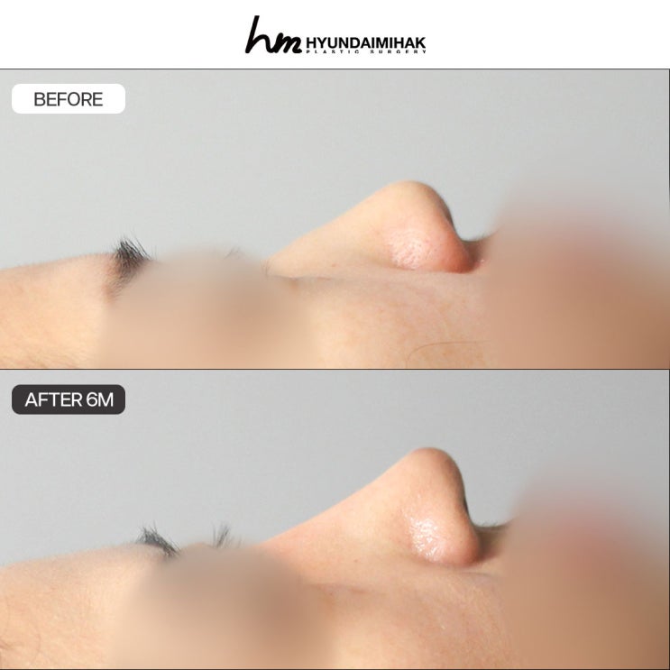 Vì sao nên thực hiện nâng mũi bằng sụn sườn hiến tặng và sụn sườn tự thân tại Thẩm mỹ Hyundai?