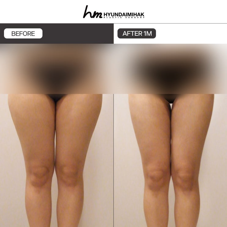 Hút mỡ thân dưới: Giải pháp thay đổi sự tự tin