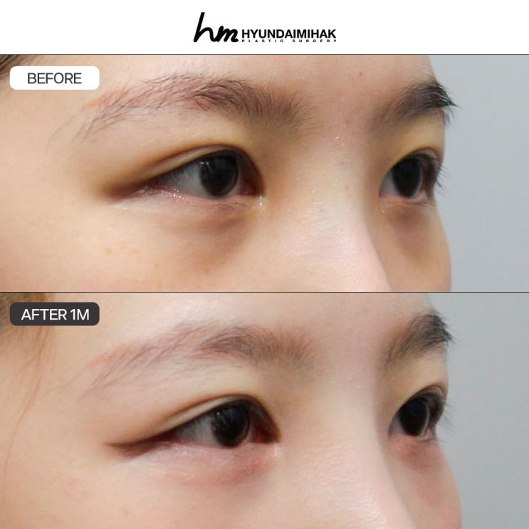 Bí quyết thay đổi ấn tượng đầu tiên tại thẩm mỹ mắt khu vực ga Sinsa