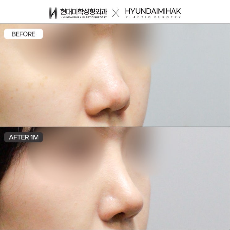 Nâng mũi bằng sụn sườn tự thân để có ca phẫu thuật ổn định và an toàn