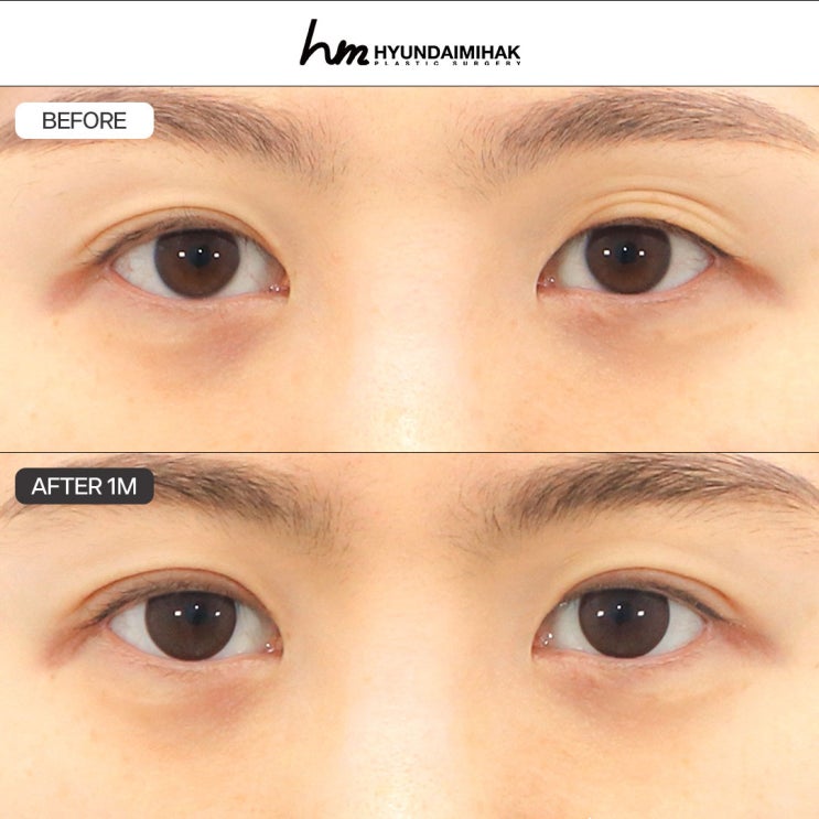FAQ về tái phẫu thuật cắt mí đôi │ Vui lòng đọc kỹ trước khi quyết định tái phẫu thuật