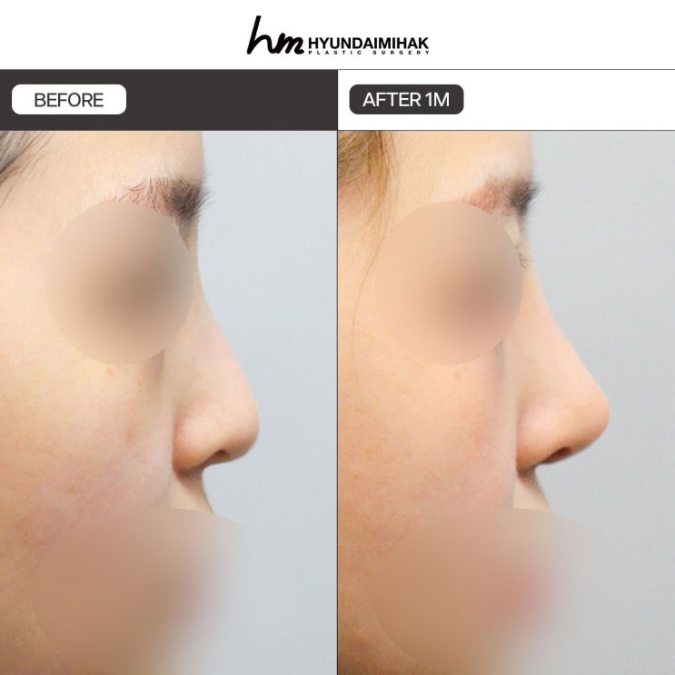 Cách lựa chọn một bệnh viện nâng mũi thật sự giỏi