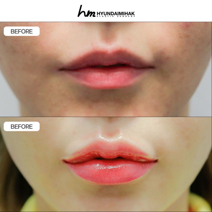 Chi phí thẩm mỹ môi: phương pháp cải thiện đường viền môi chỉ trong một lần