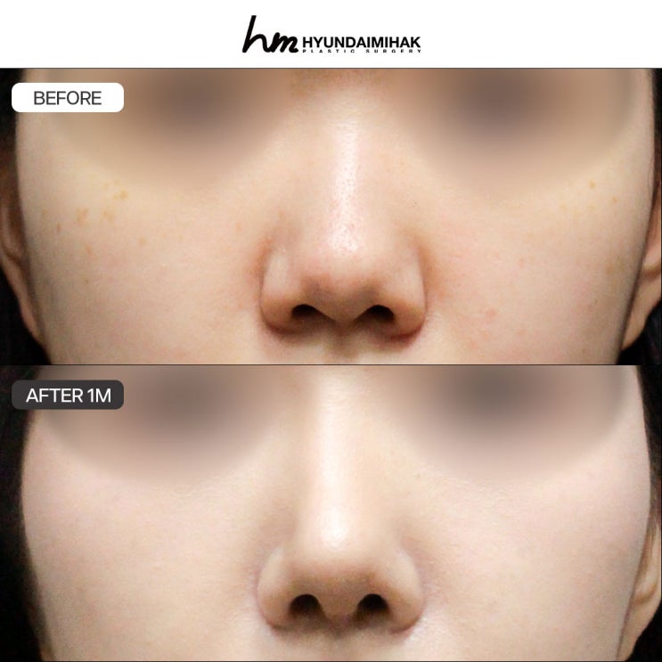 Dáng mũi line thẳng hơi cong, hoàn thiện vẻ đẹp tự nhiên và tinh tế