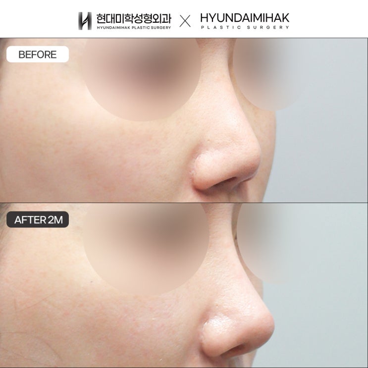 Để giải quyết những băn khoăn về nâng mũi bằng sụn sườn