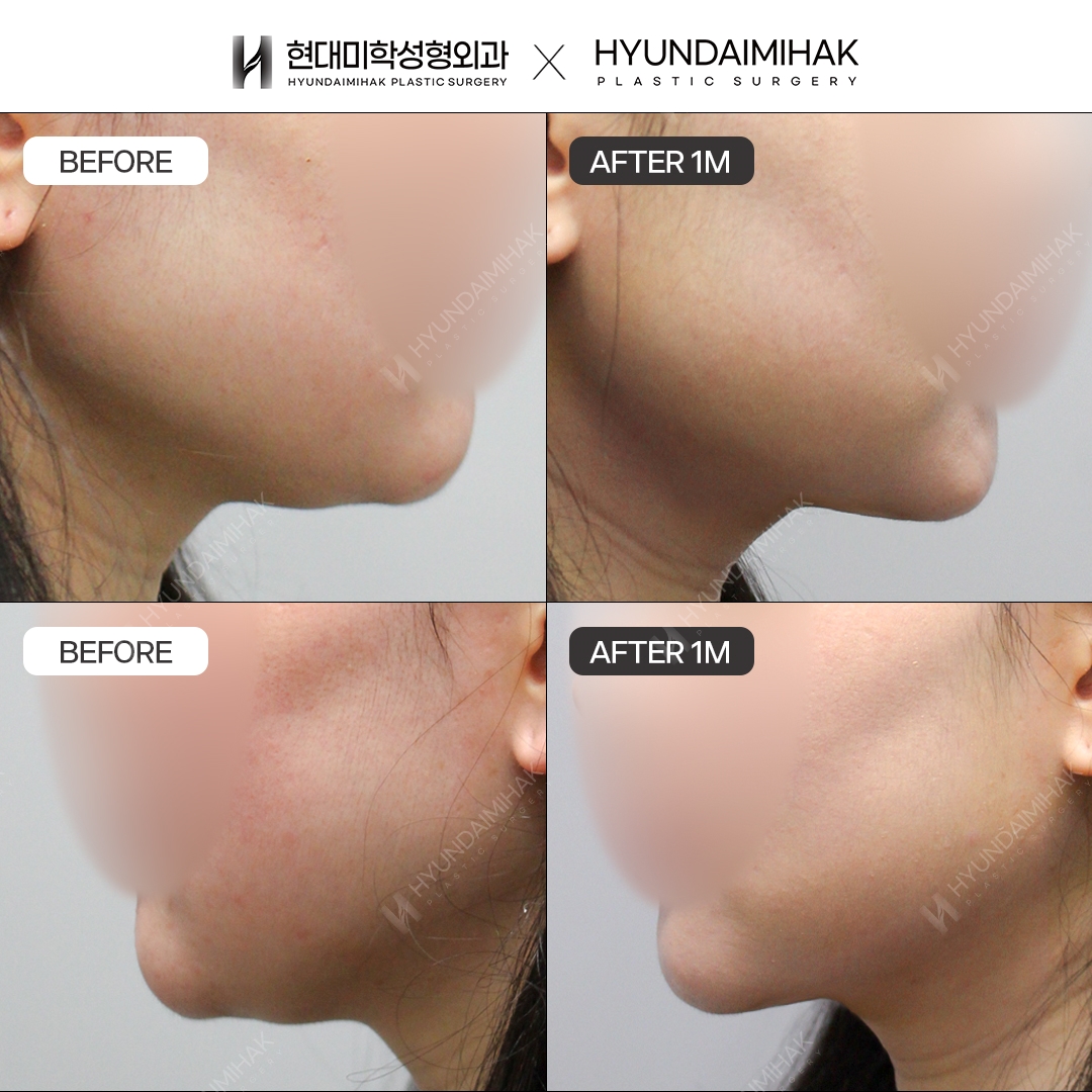 [Phẫu thuật trẻ hóa] Căng chỉ sau 1 tháng