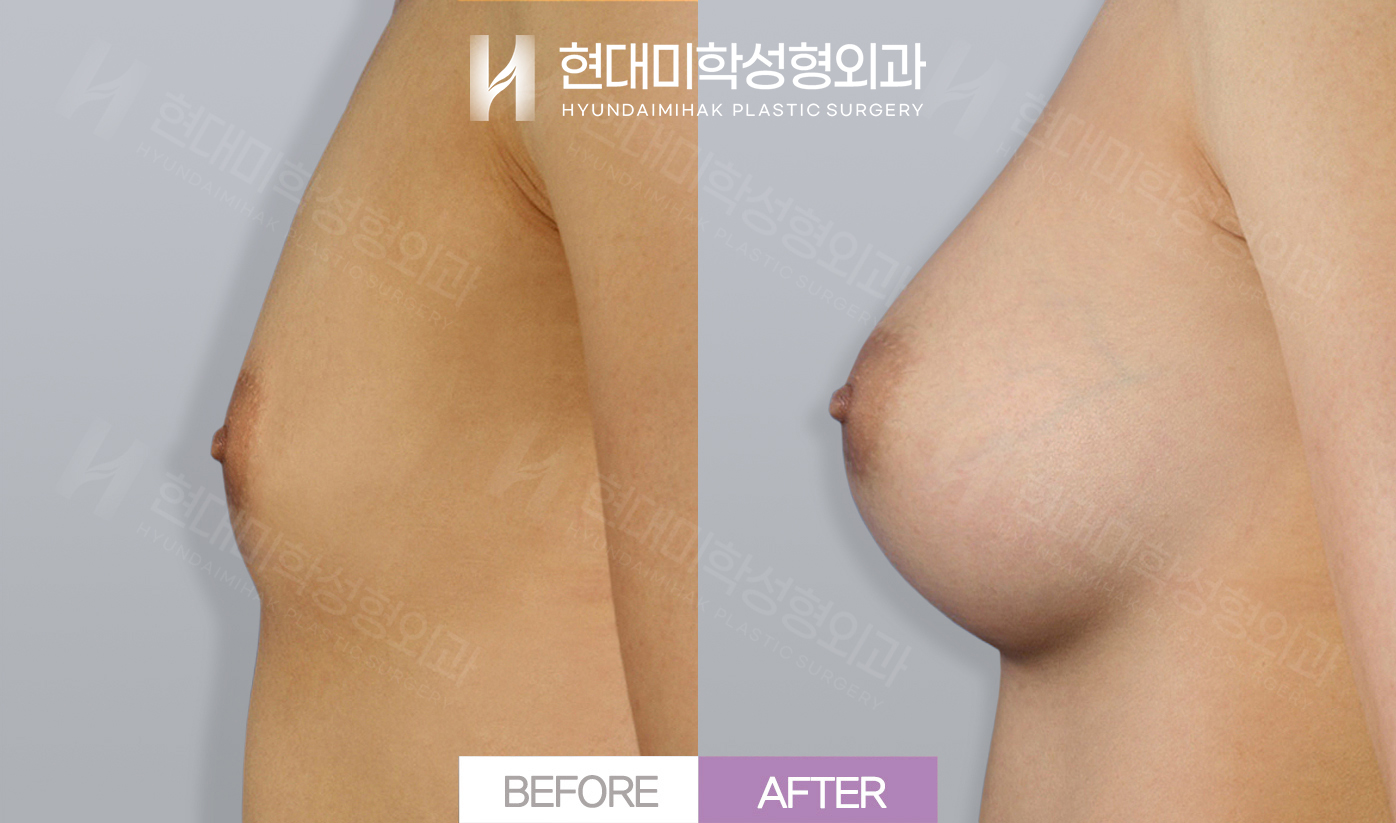 Nâng ngực (silicone)