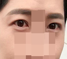 Đánh giá phẫu thuật mí mắt đôi cho nam ㅋㅋㅋ