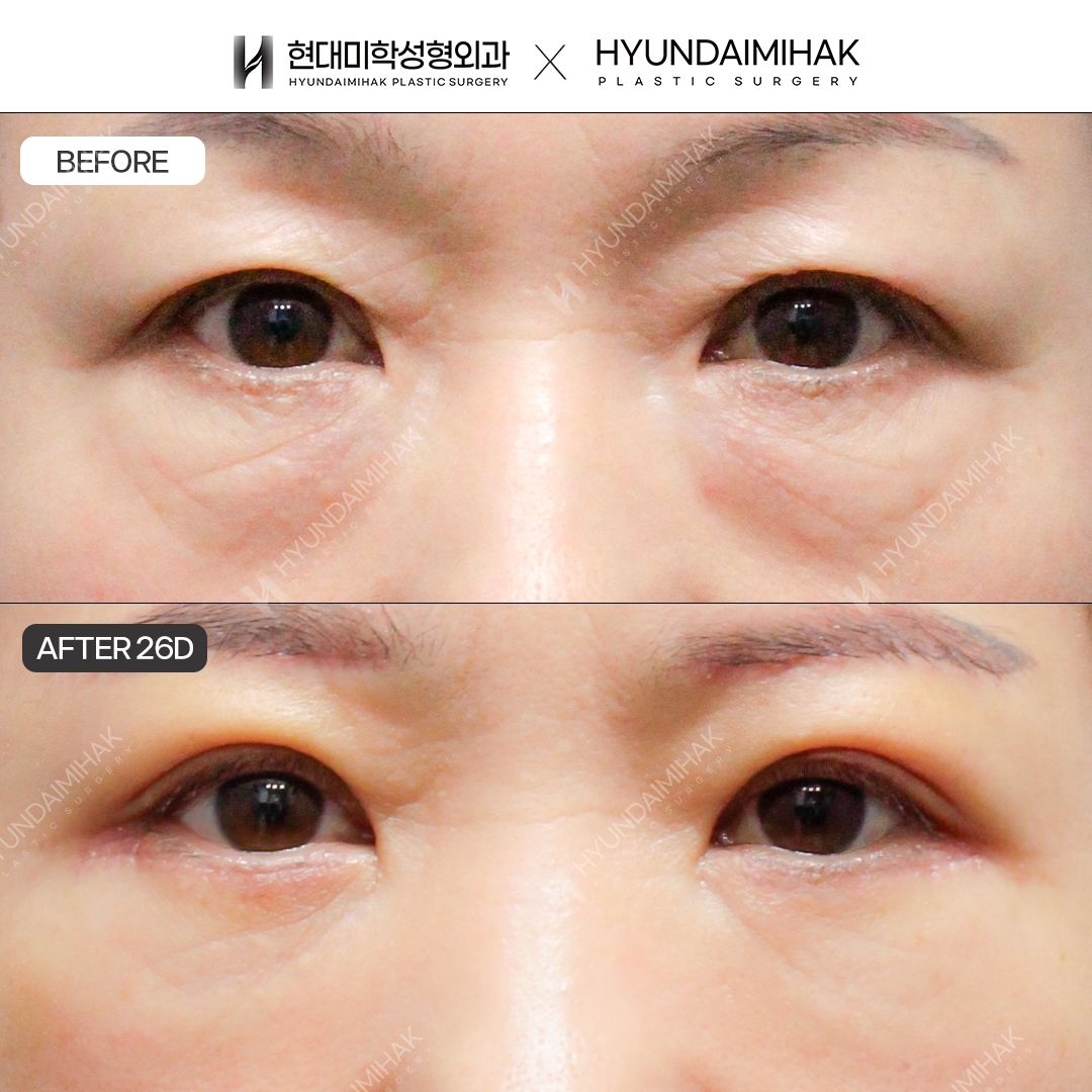 [Phẫu thuật mắt trung niên] Cắt mí trên + cắt mí dưới + tái định vị mỡ dưới mắt