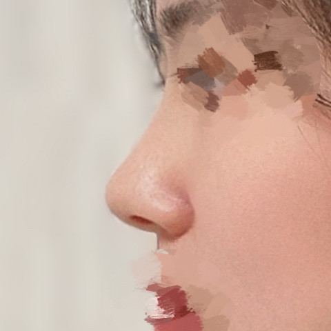 Hooked-nose surgery review