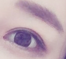 Eye revision swelling went down quickly... good lol