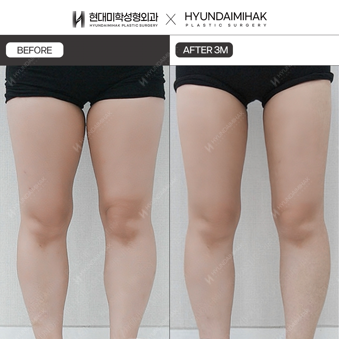 Tháng thứ 3 sau hút mỡ đùi