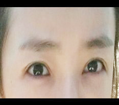 Sửa mắt thành công rồi!