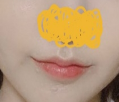 Phẫu thuật khóe miệng thành công >_<
