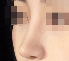 I recommend Thẩm mỹ Hyundai to anyone who wants pretty nose surgery!!!!!