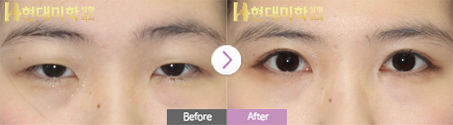 Phương pháp rạch, chỉnh cơ nâng mi, mở góc mắt trong