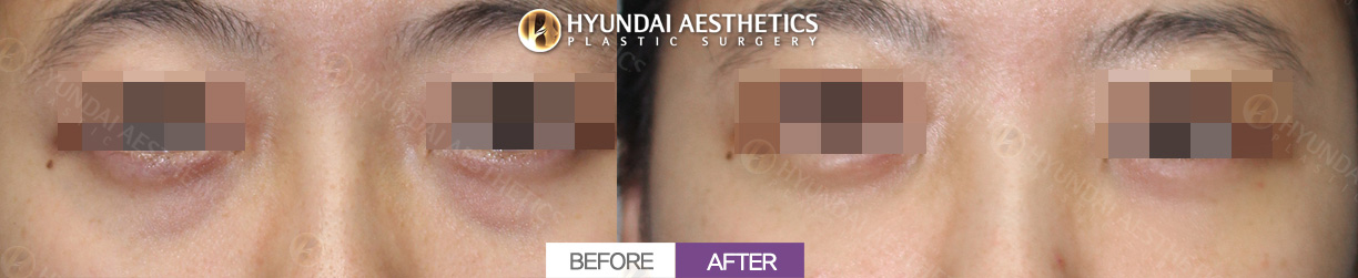 Tái định vị mỡ dưới mắt sau 1 tháng