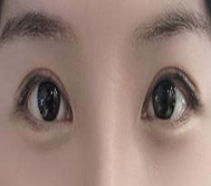 Mí nhấn bị tuột nên mình làm lại mí cắt với bác sĩ Hwang Ho