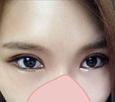 Hơi ngại nhưng tôi đăng review làm mí đôi và mở khóe toàn phần^^