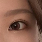 Sau phẫu thuật tái tạo mắt thấy đời thật đáng sống ㅠ