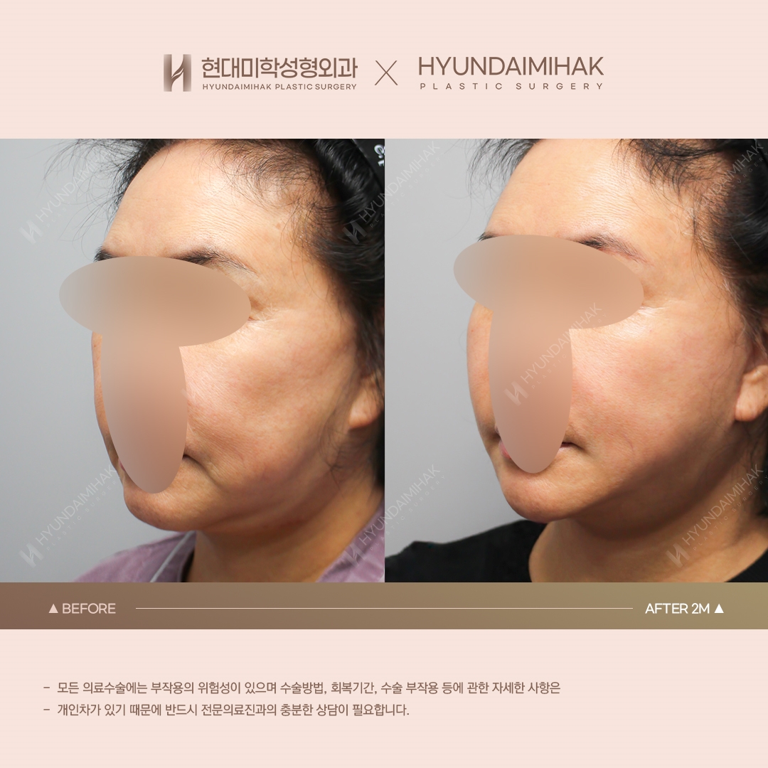 [Phẫu thuật trẻ hóa] Căng chỉ sau 2 tháng