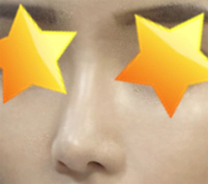 Review phẫu thuật mũi