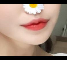 Mình đã phẫu thuật khóe môi♡