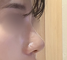 Tôi đã xử lý xong mũi gồ