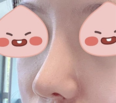 Cuối cùng cũng đến tháng thứ 6 sau mổ chỉnh hình mũi hh