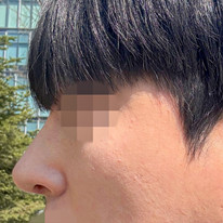 Phẫu thuật mũi gồ cho nam