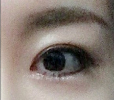 Tái phẫu thuật mắt thành công hoàn toàn ^^