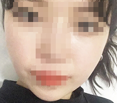 Thu gọn gò má