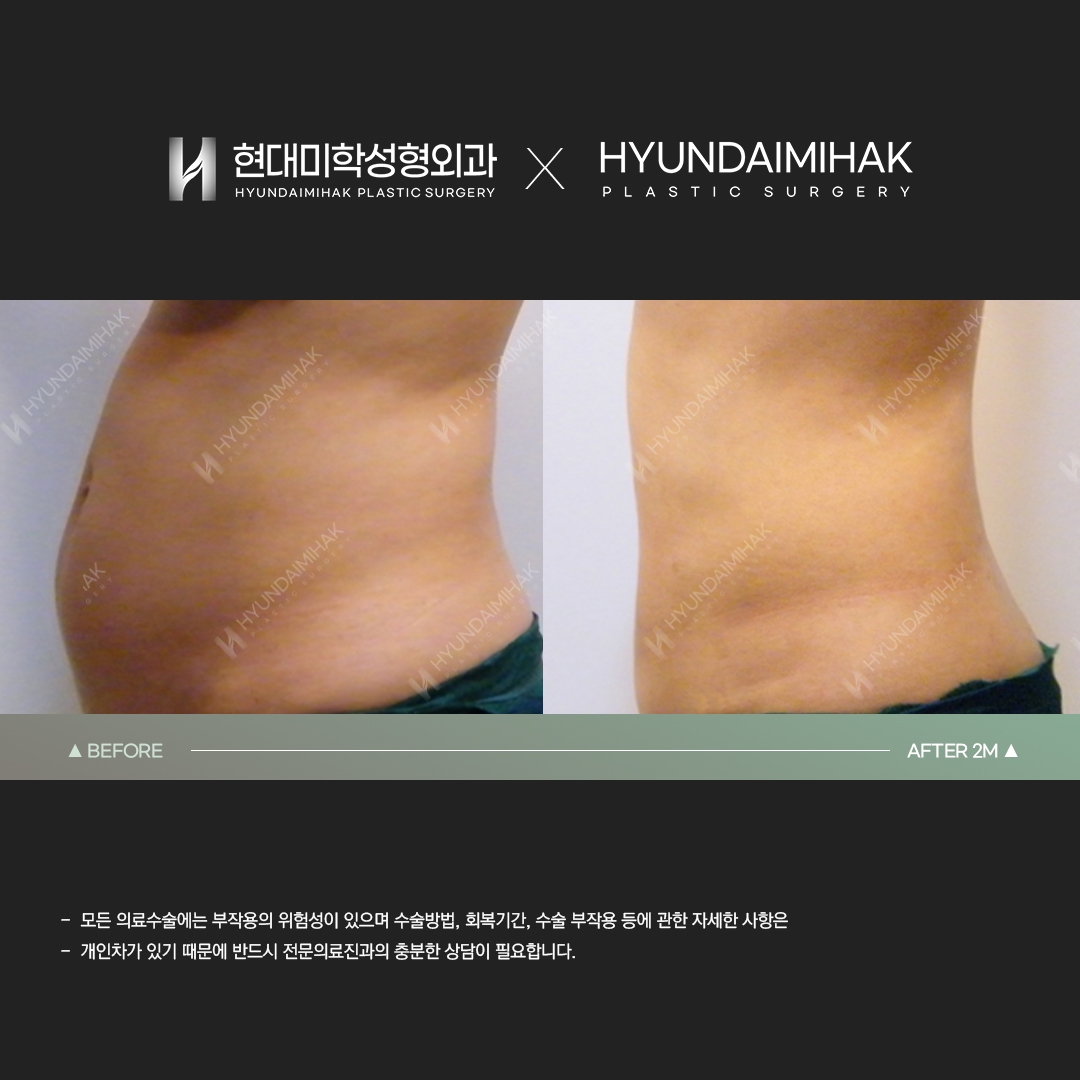 Hút mỡ bụng sau 2 tháng
