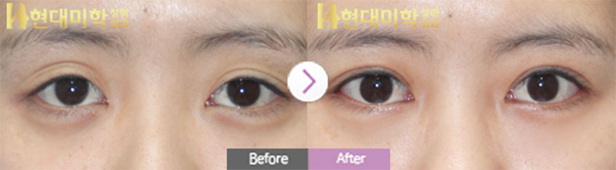Tái phẫu thuật mắt rạch, chỉnh cơ nâng mi, mở góc mắt ngoài, hạ đuôi mắt