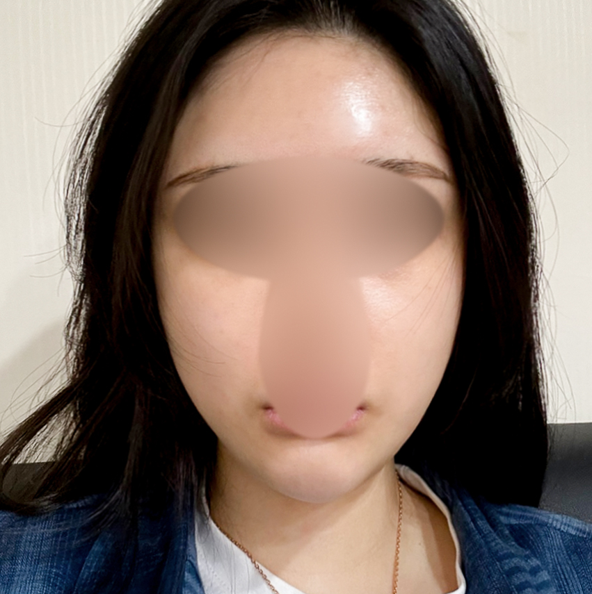 Bulldog cheeks, smile lines, and face shape refined✨ Thread-lift review