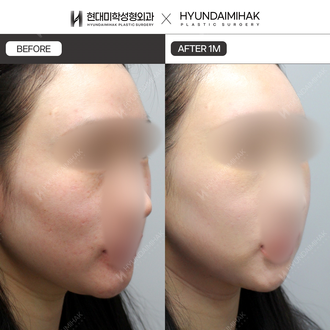 [Phẫu thuật trẻ hóa] Căng chỉ sau 1 tháng