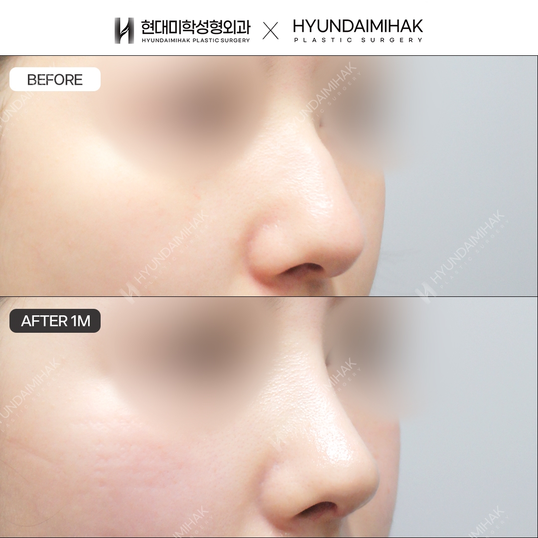 [Phẫu thuật mũi gồ] Sống mũi + đầu mũi sau 1 tháng