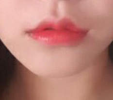 Lip surgery at Thẩm mỹ Hyundai is seriously highly recommended;
