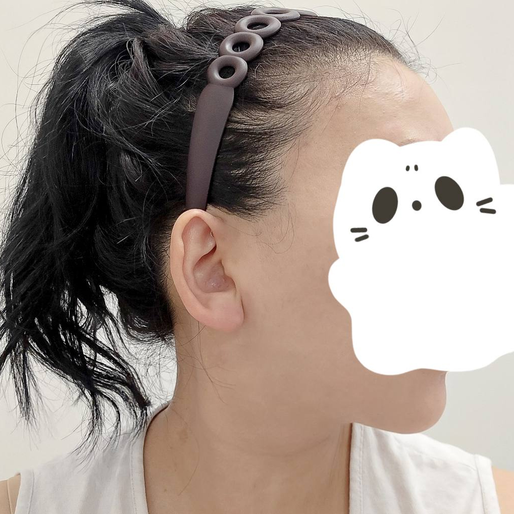 Hút mỡ mặt + nọng cằm đỉnh cao, ai đang tìm hiểu hút mỡ mặt và cằm nhất định xem nhé