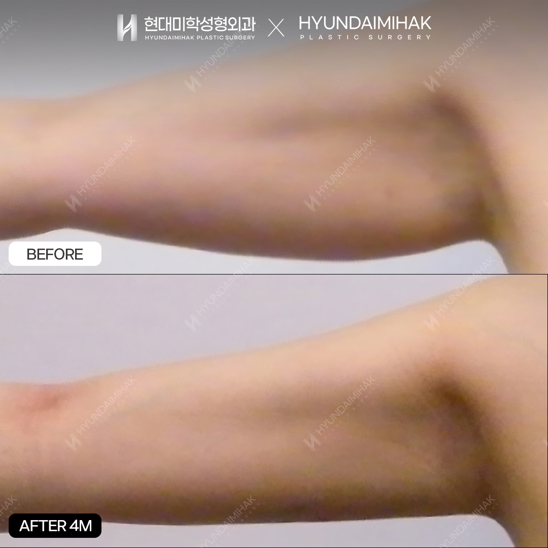 Hút mỡ bắp tay sau 4 tháng